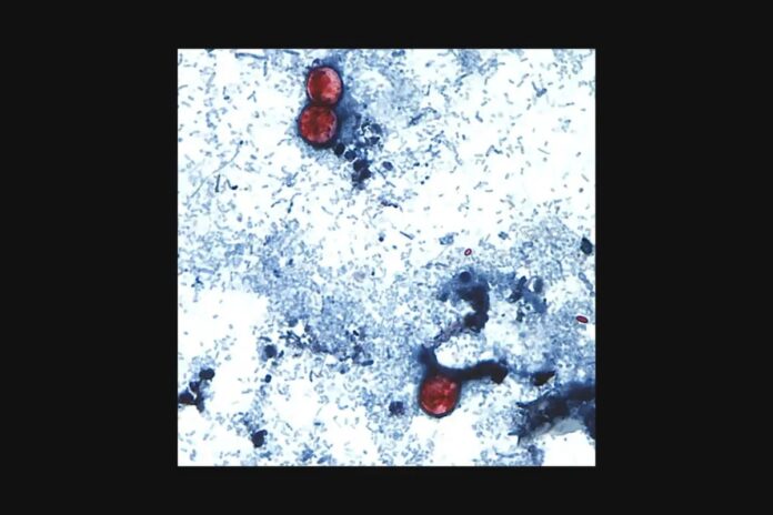 Cyclospora: What you should know about the diarrhea bug